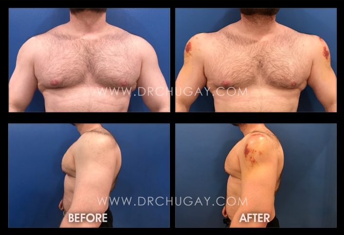 36yo male before and one week after insertion of custom deltoid implants with 3.2cm of projection.