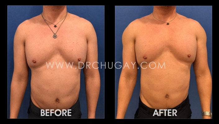41yo male before and after deltoid augmentation with size 1 implants