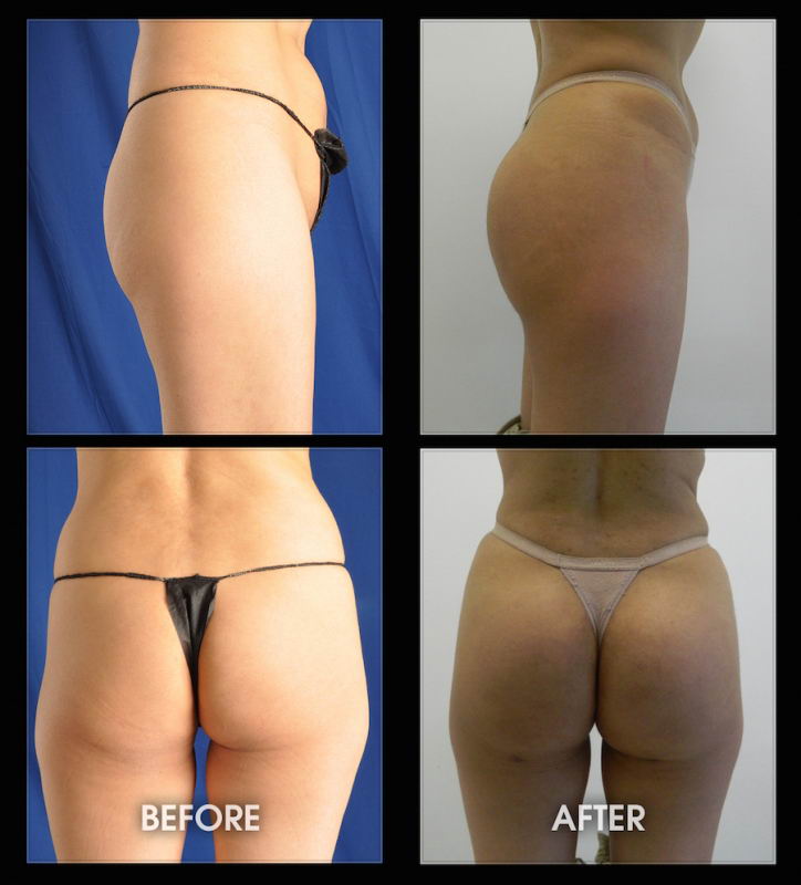 Before & After Buttock Augmentation Gallery - Cosmetic Surgery