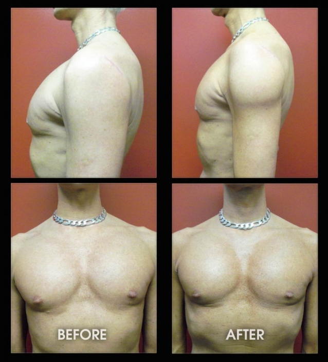 Male Deltoid Implants - Plastic Surgery for Men - Muscle Implants - Before and After Photos - Los Angeles